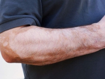 甲醛超標(biāo)和白癜風(fēng)有關(guān)系嗎？裝修污染對(duì)人體影響極大！